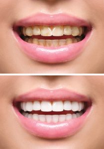 Woman teeth before and after whitening. Oral care